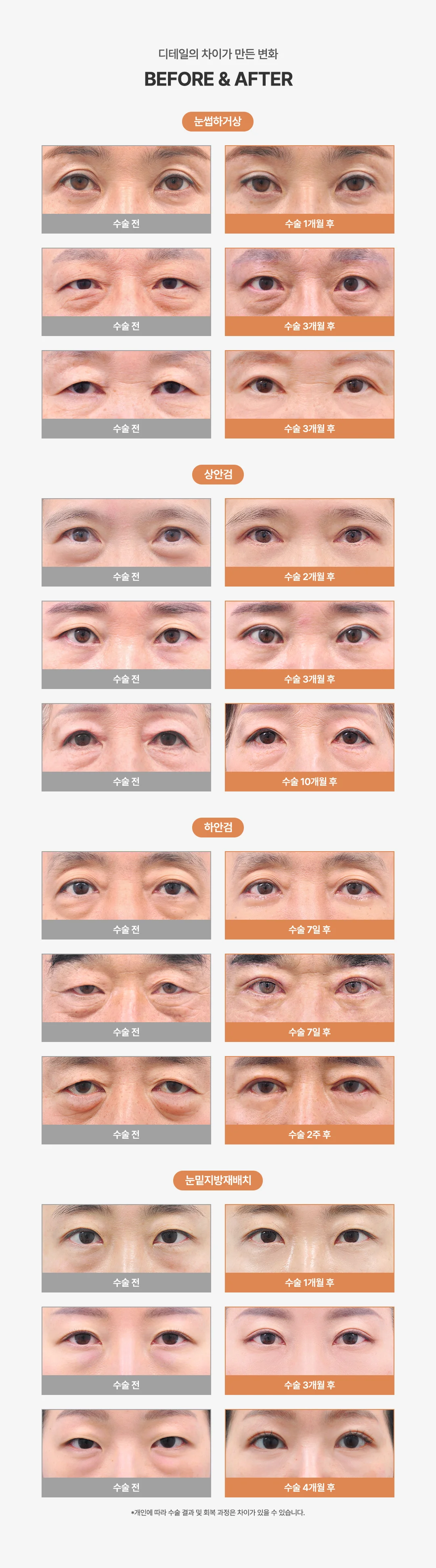 올로 중년눈성형 비포애프터