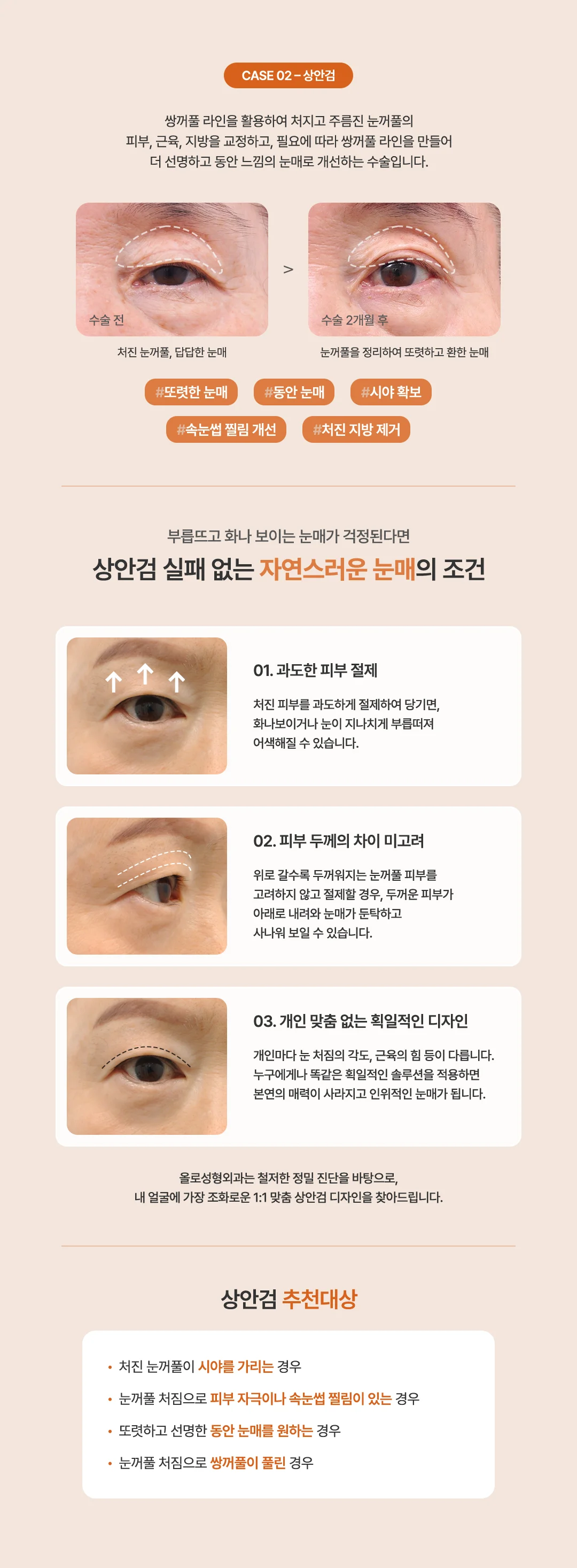 올로 중년눈성형 상안검