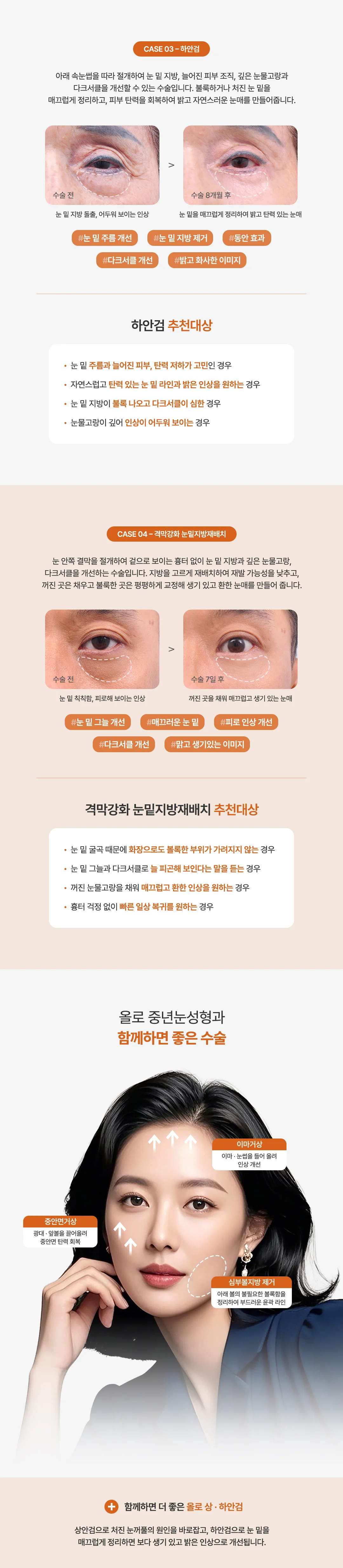 올로 중년눈성형 하안검 및 눈밑지방재배치
